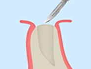 歯ぐきの切開