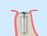 インプラント埋入